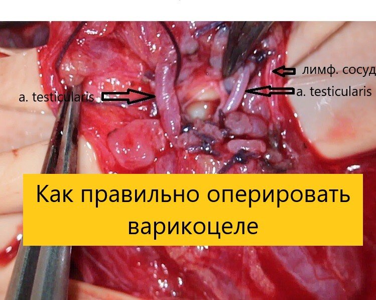 На фото семенной канатик с уже перевязанным внутренними семенными венами, видны (отмечены стрелками) 2 сохраненные яичковые артерии и лимфатический сосуд.