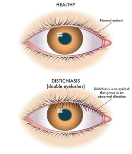 Различия между нормальными ресницами и ресницами, растущими при дистихиазе, заключаются в их внешнем виде.