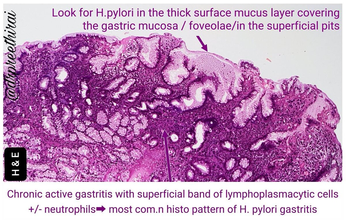 Изменения в тканях желудка, вызванные H. pylori 