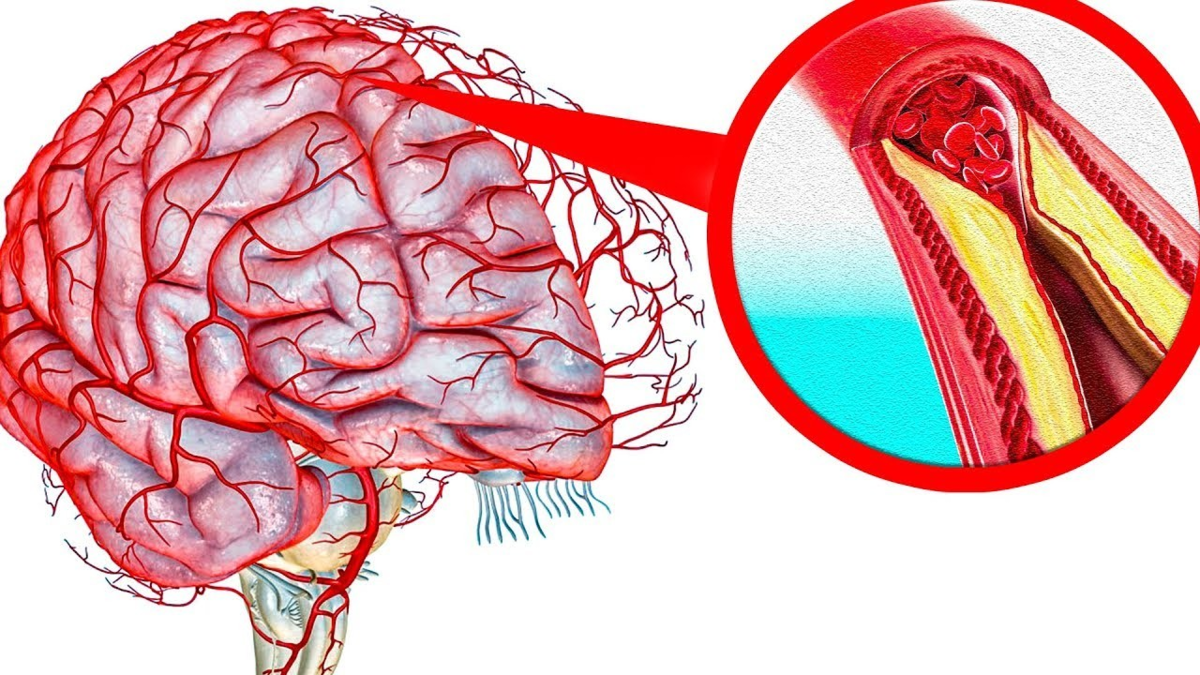 Лечение сосудов мозга — народные рецепты для головы