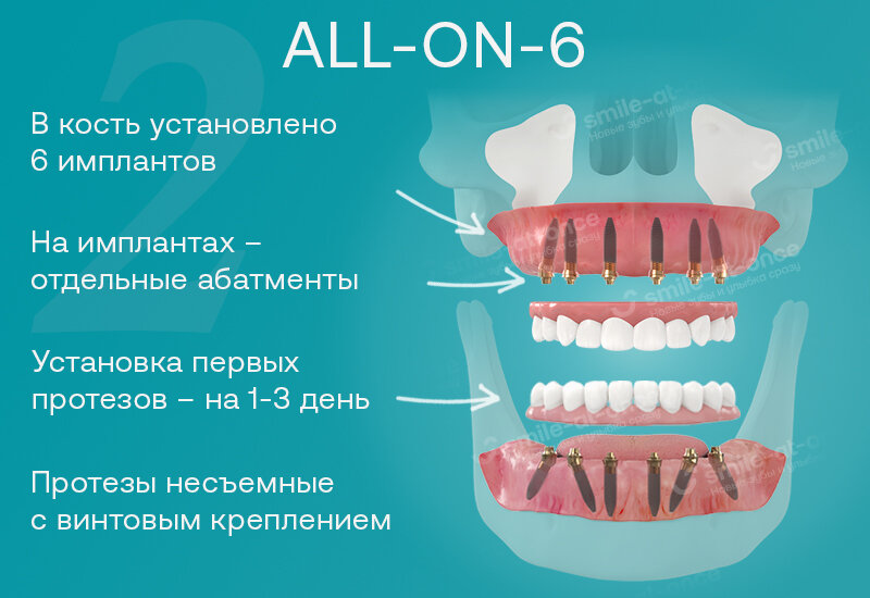 Так выглядит имплантация all-on-6, или все зубы на 6 имплантах. Фотоколлаж: Smile-at-Once.ru.