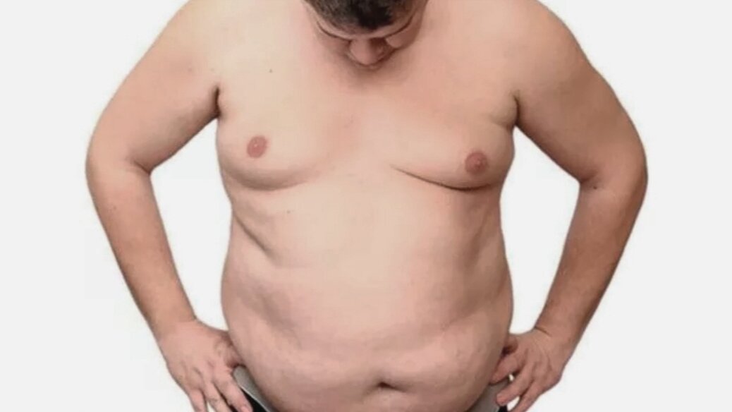 Мужчина преобретает женоподобное телосложение, могут увеличиться молочные железы 