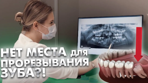 Download Video: Что делать, если у ребенка дефицит места в зубном ряду для прорезывания постоянных зубов?