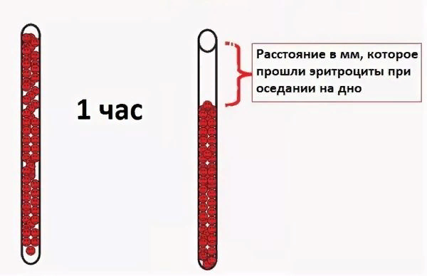 Что такое повышенное соэ. Скорость оседания эритроцитов. скорость оседания соэ. измерение соэ по панченкову. соэ капилляр панченкова.