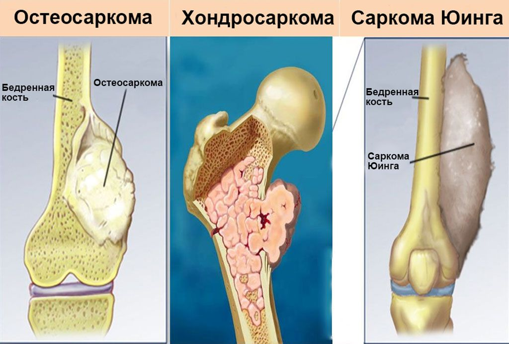 Рак кости ноги. Саркома бедренной кости. Опухоль Юинга бедренной кости. Остеосаркома бедренной кости.