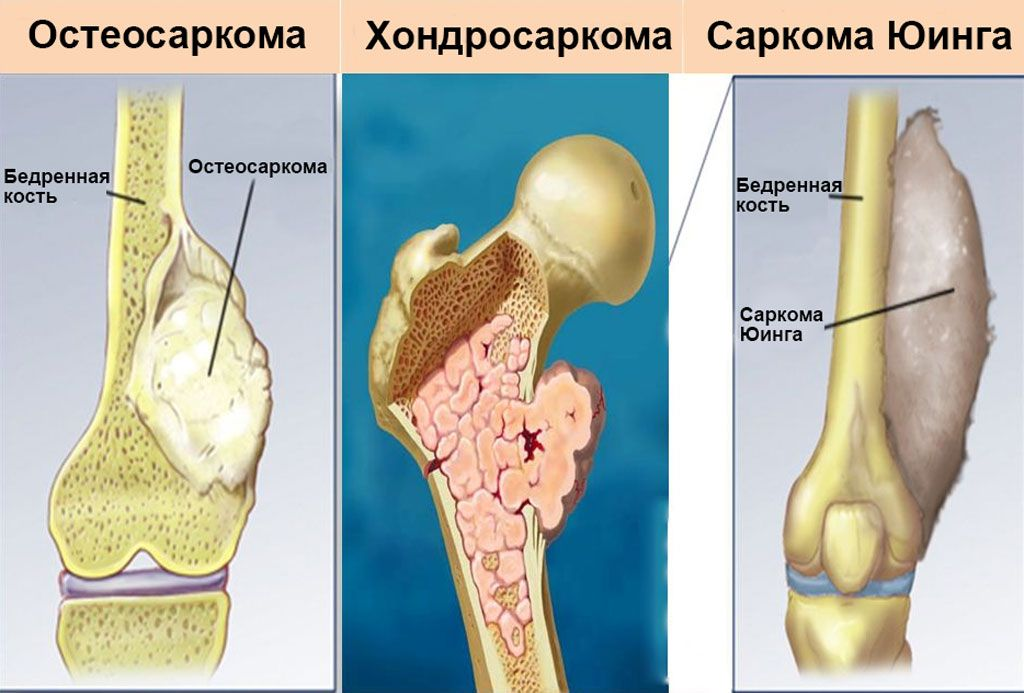 Первые признаки рака кости