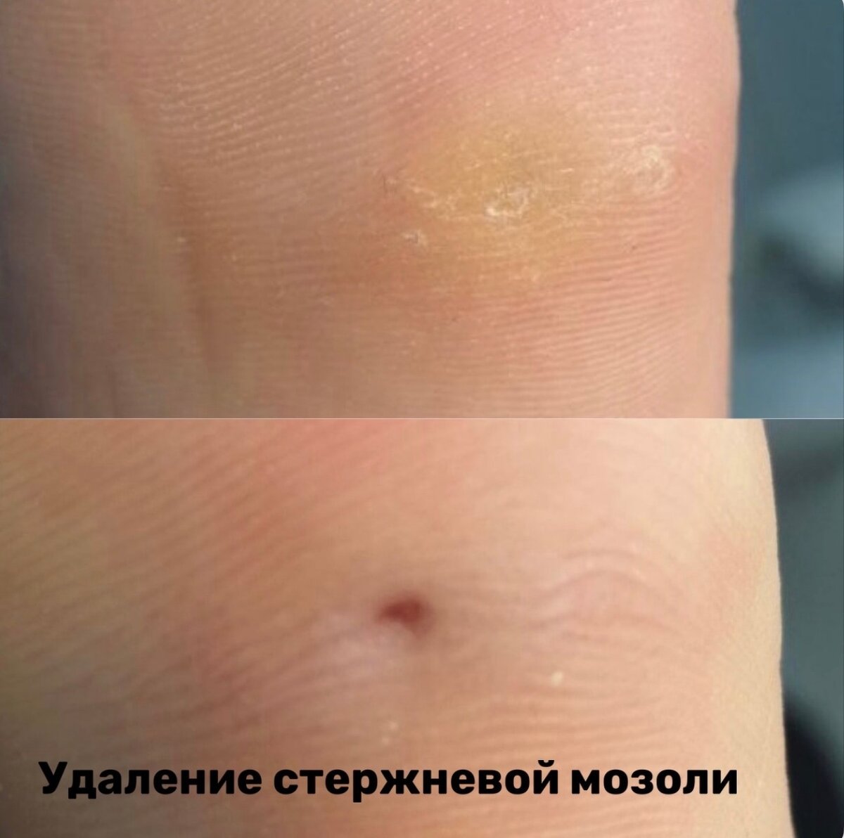 Как выглядит стержневая мозоль на пальце фото