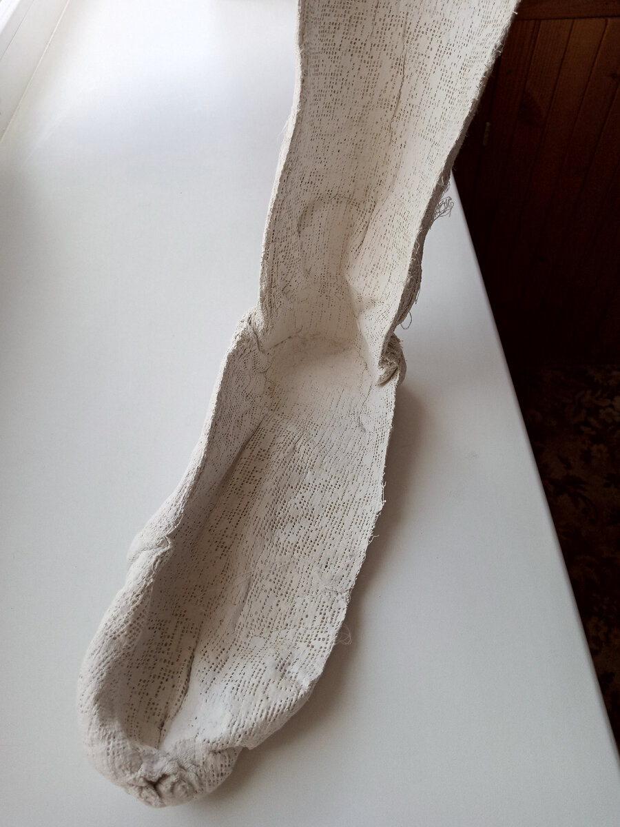 На задней части лангеты явно видны травмирующие части гипса, сдавливавшие большеберцовый нерв в области голеностопа