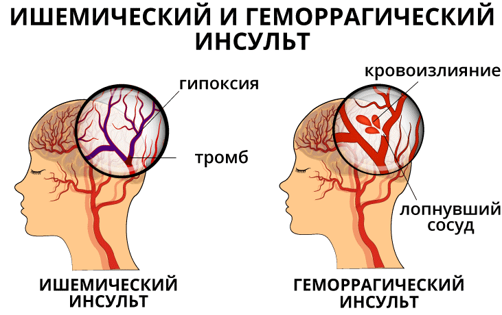 Ишемический инсульт 2023