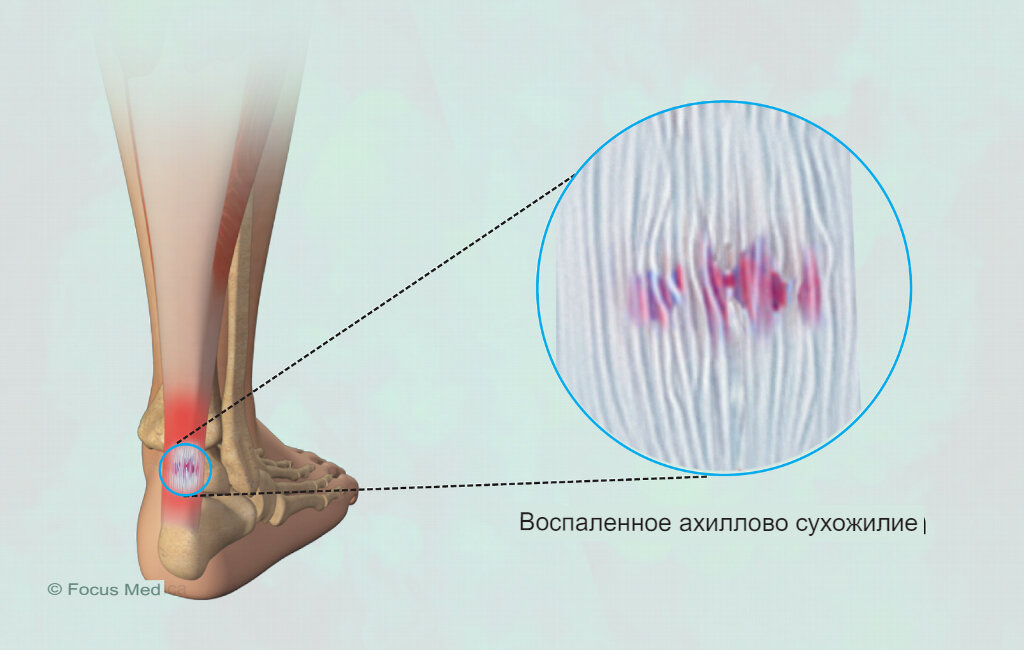 Боль в пятке (воспаление Ахиллова сухожилия)