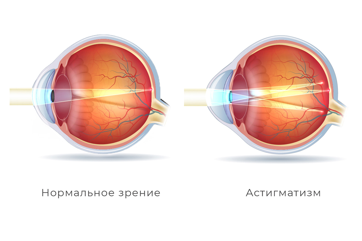 Нормальное зрение. Профилактика глаукомы глаза. Симптомы глаукомы инфографика.