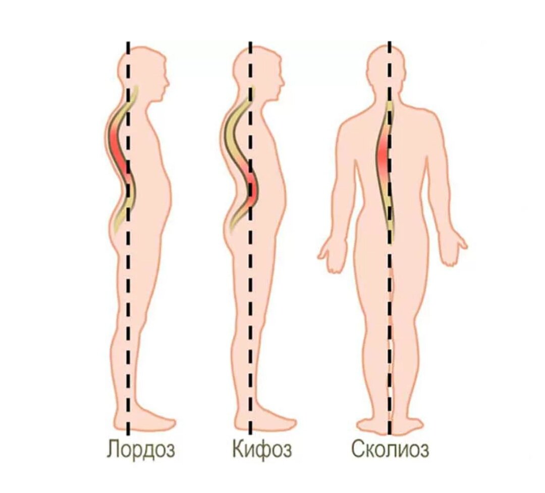 Лордоз картинки позвоночника