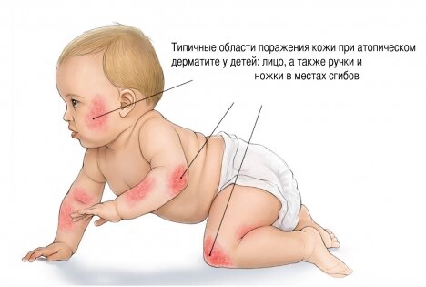 Классификация урогенитального кандидоза (молочницы) у детей