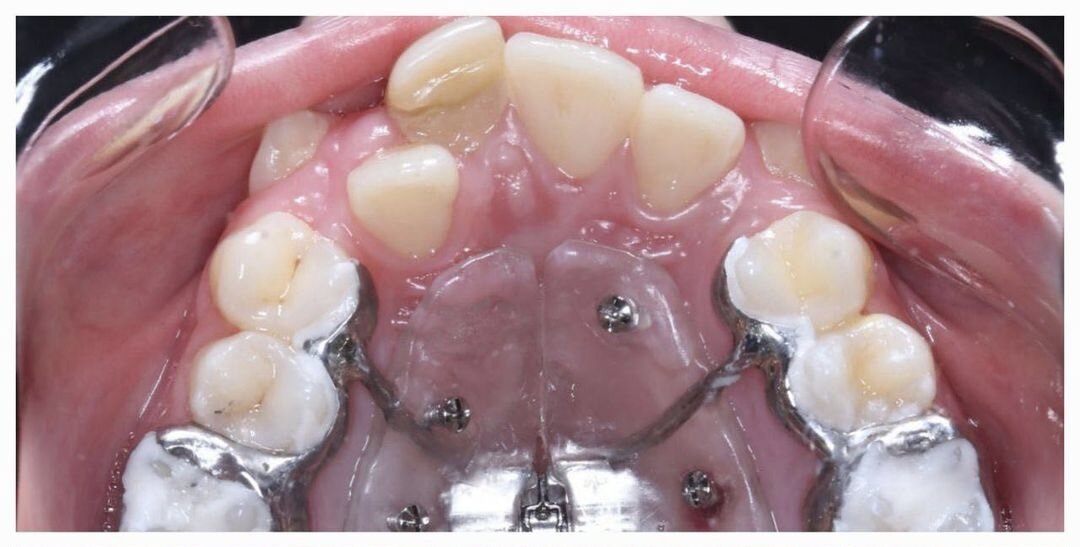 Фиксация аппарата