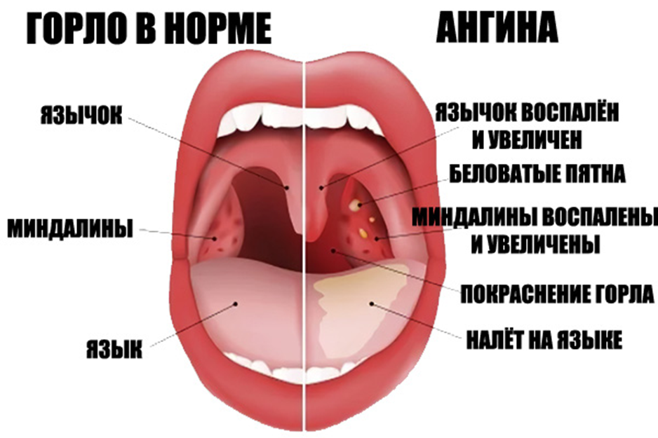 Острой стороной. Фарингит зев гиперемирован.