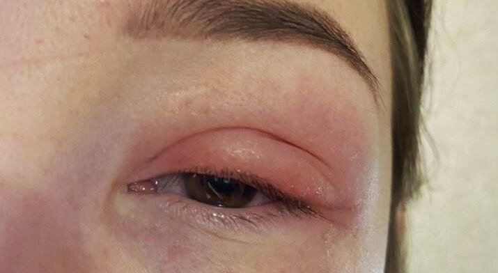 Аллергическая реакция на клей при наращивании ресниц