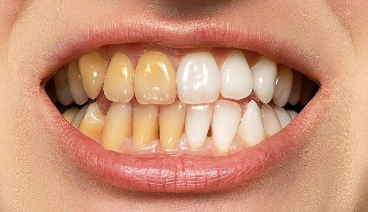 Зубы теряют белизну