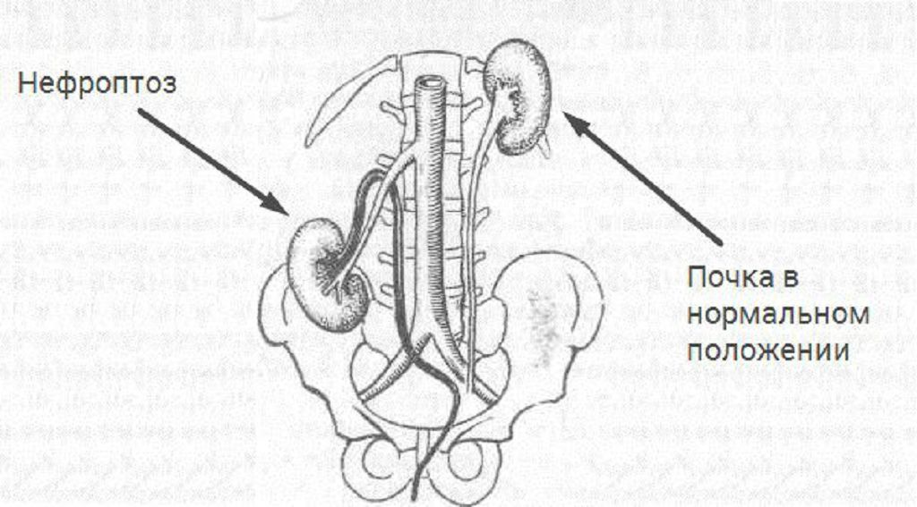 Опущение почки причины и последствия. Нефроптоз почки 1 степени. Нефроптоз 3 степени правой почки. Подвижная почка симптомы. Нефроптоз почек 2 степени.