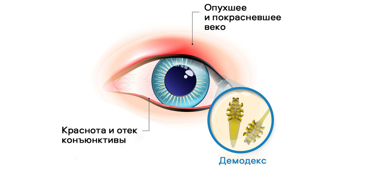 Симптомы демодекоза (клиническая картина демодекоза)