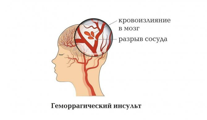 Кровоизлияние в головной мозг. Геморрагический инсульт паренхиматозное кровоизлияние. Паренхиматозно-субарахноидальное кровоизлияние.