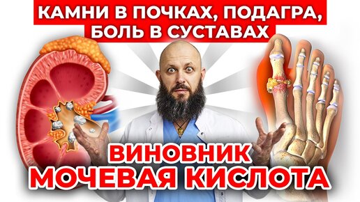 Мочевая кислота — страшная ОПАСНОСТЬ! Диета для выведения мочевой кислоты