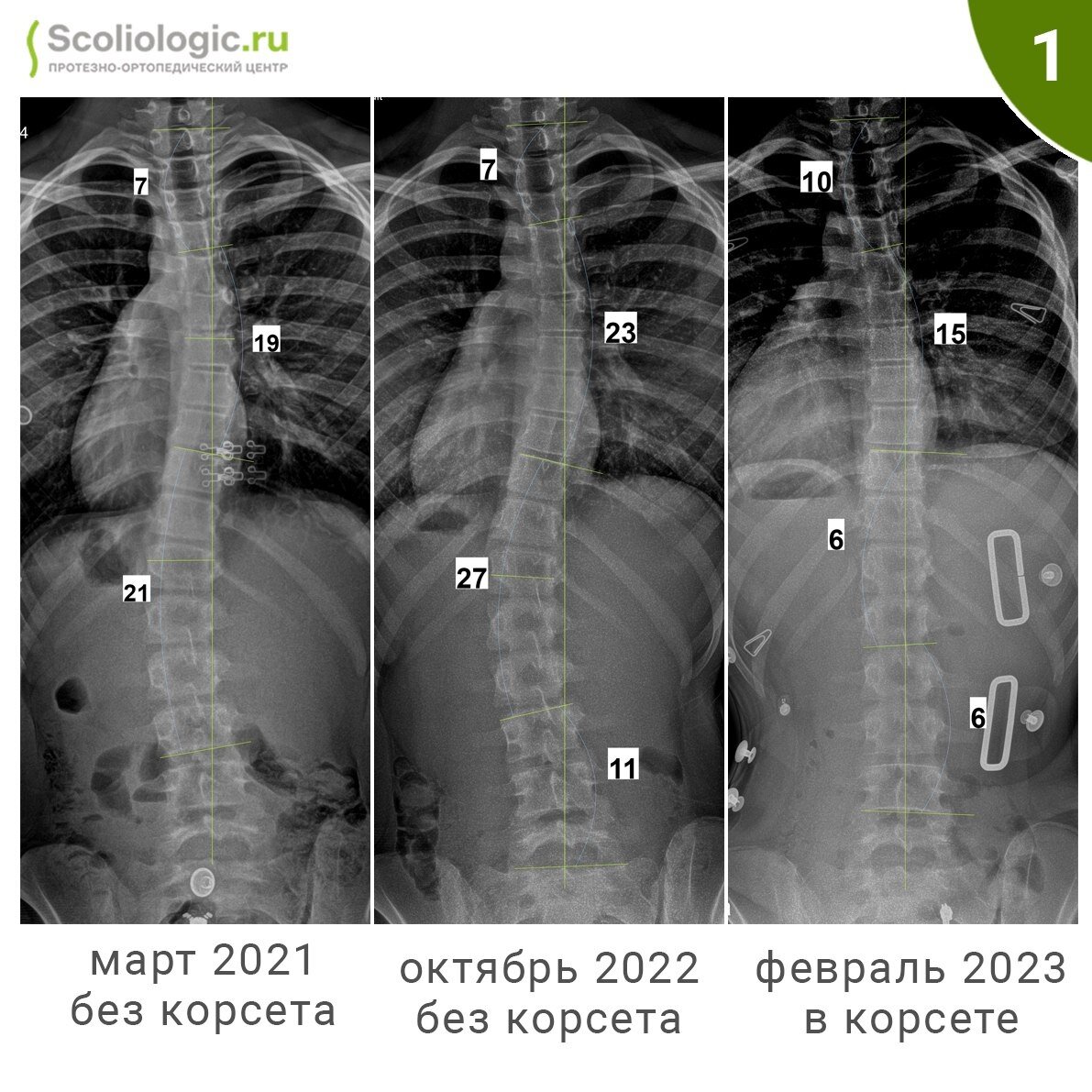 Сколиоз позвоночника у взрослых: лечение, симптомы, профилактика | Клиника Temed