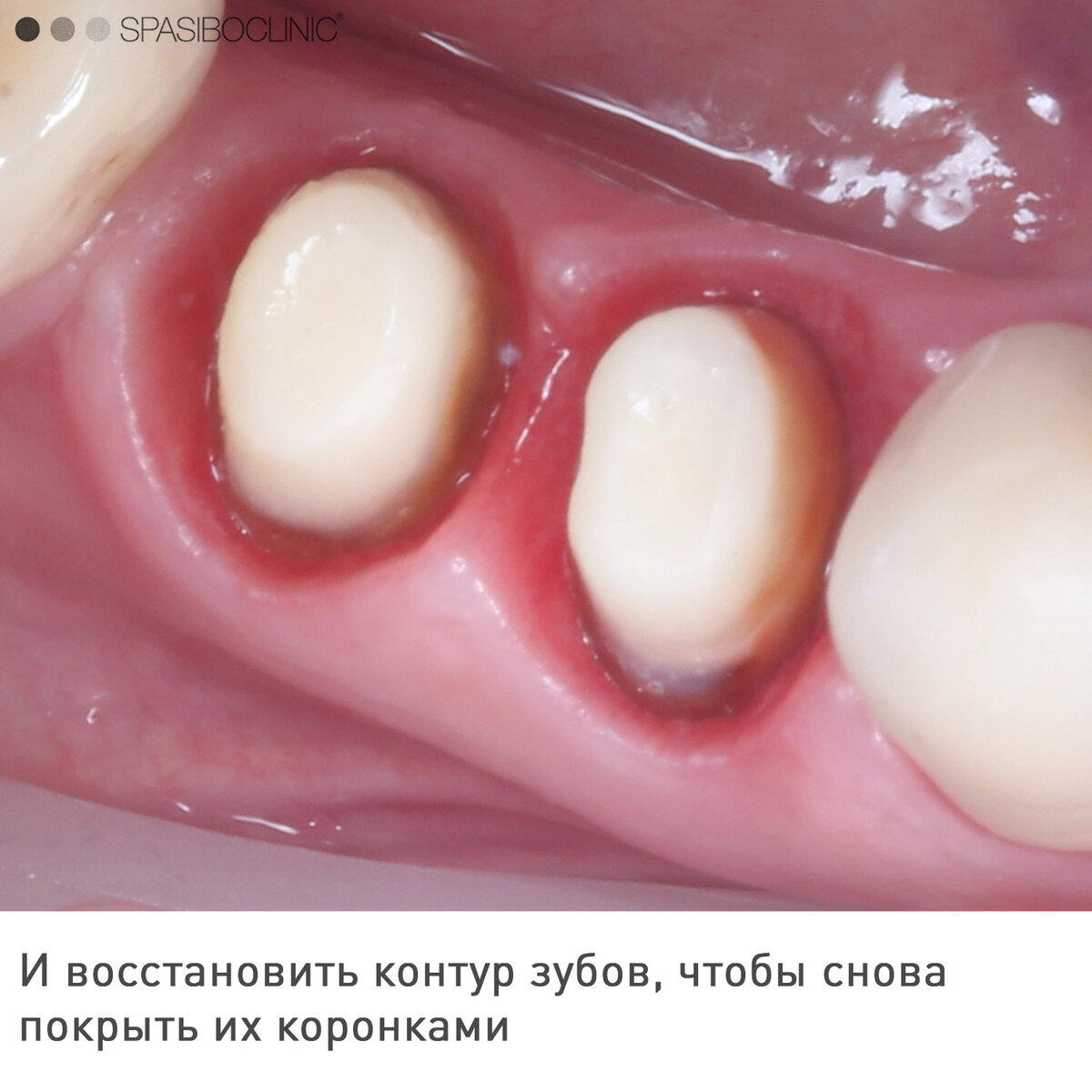 Почему болит десна под коронкой?