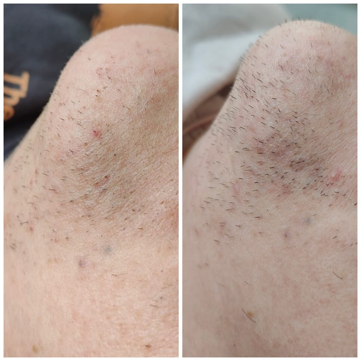 Разница между фото 3 недели. Перед первым сеансом (слева) и после 1ого сеанса (справа). Прирост - норма. 