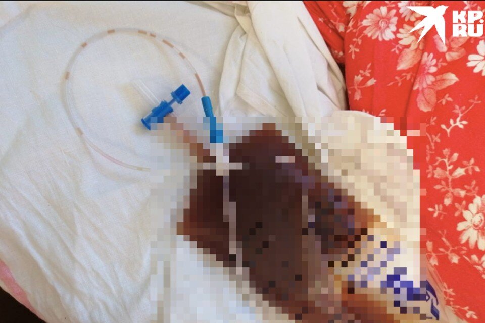    Мужчине срезали трубку из почки, он с обострением оказался в больнице. Фото: Предоставлено героями публикации