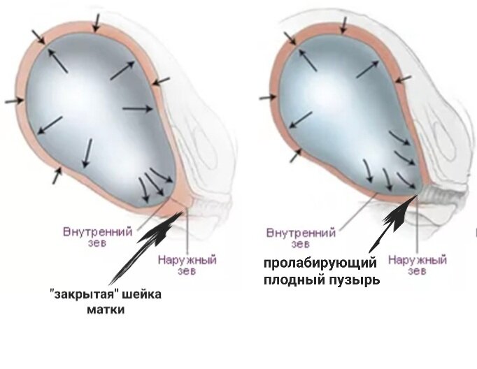 Внутренний зев. Пролабирование плодного пузыря. Пролабирование плодного пузыря в цервикальный канал. Матка с пролабированием плодного пузыря. Пролабирование плодного пузыря в шейку матки.