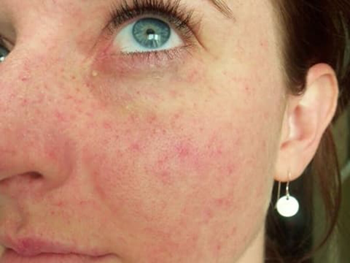 Аллергическая сыпь на лице