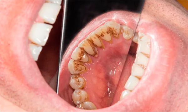 Как предотвратить отложение зубного камня на зубах? | Портал о зубах ...