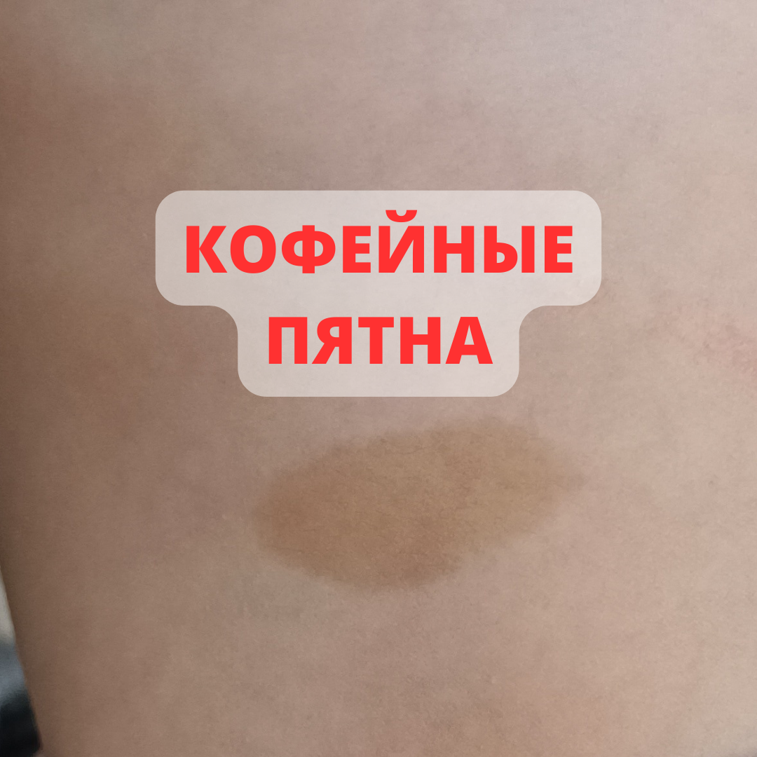 Пятна на коже