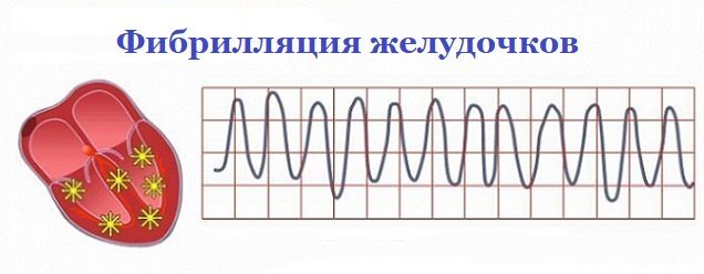 Так выглядит фибрилляция желудочков на экране монитора