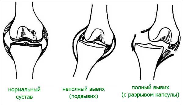 Перелом позвонка (fractura vertebrae)