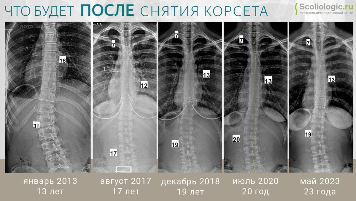 Что будет после отмены корсета Шено при сколиозе | Протезно ...
