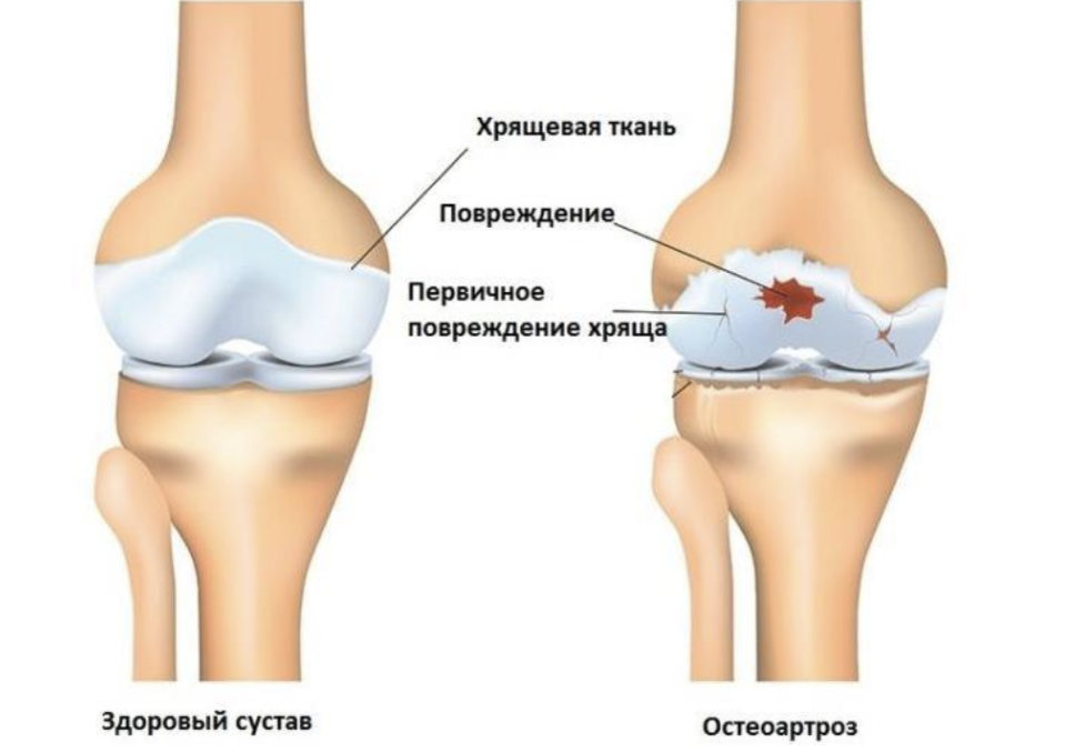 Боль, ломота, ноющие ощущения в суставах считаются неизменными спутниками старения.