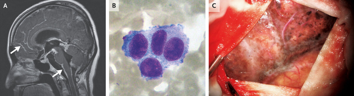   Lei Wen et al. / The New England Journal of Medicine, 2023