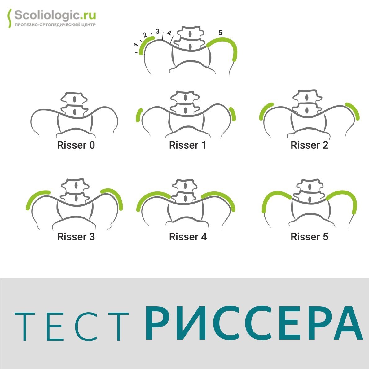 Теста риссера. Тест риссера. Тест риссера при сколиозе. Знаки риссера. Тест риссера статистика.