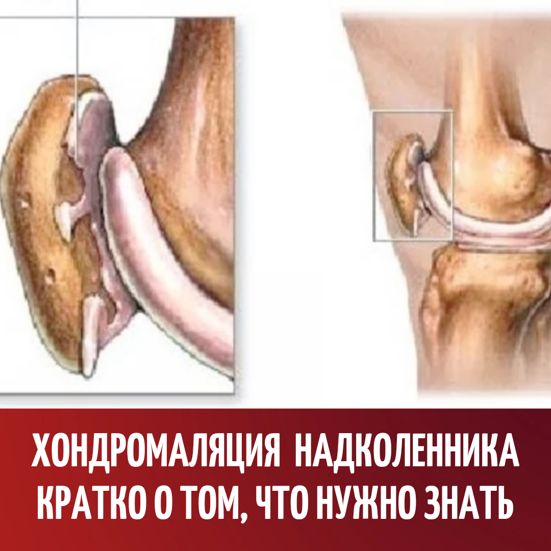 Симптомы, степени и лечение хондромаляции