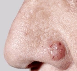 Базалиома кожи левого крыла носа, узловая форма.