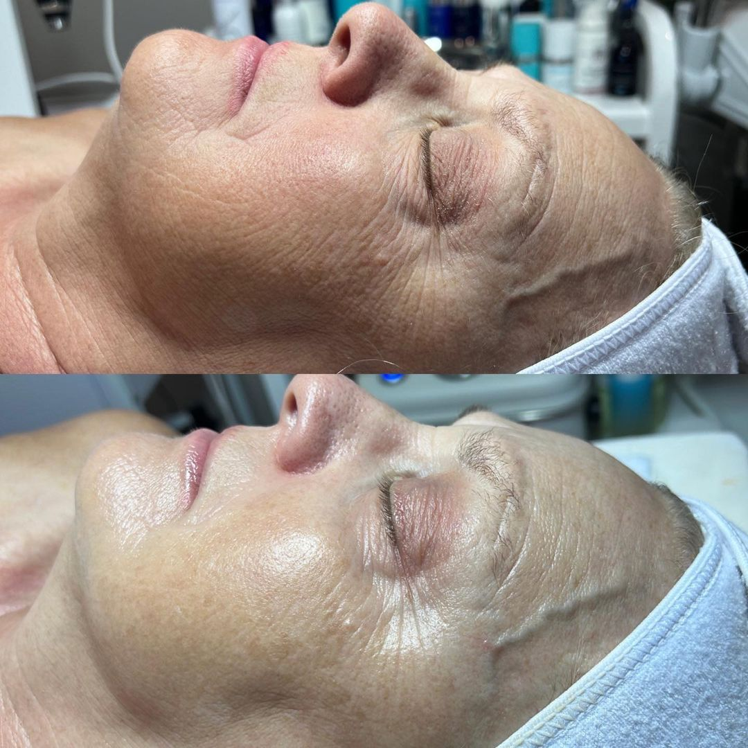 Эффект от одной процедуры Geneo-увлажнение, разглаживание мелких морщинок и сияние кожи