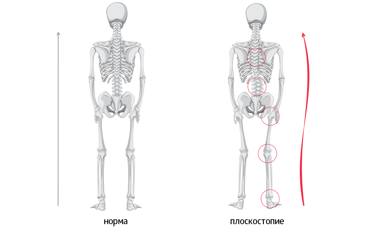 При смещении вертикальной оси страдают суставы всего скелета
