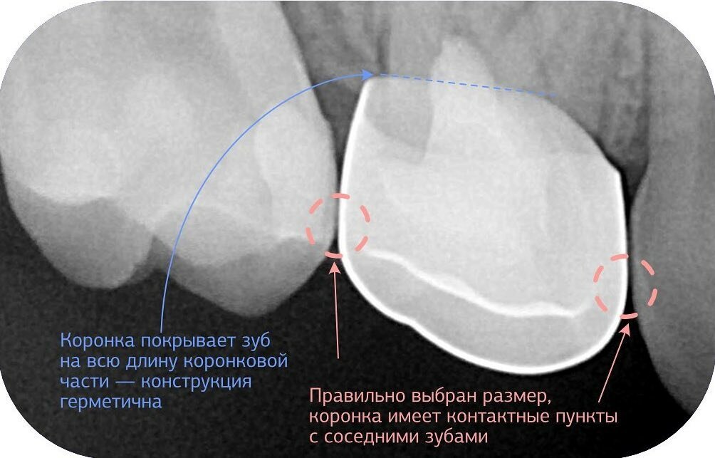 Автор лечения – детский стоматолог Галина Ерошкина