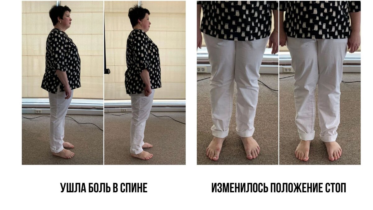 На фото Ольга С. до кинезиобаланса и сразу после. 