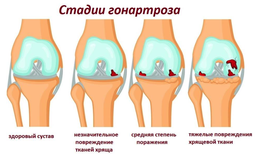 Гонартроз: степени, симптомы, лечение