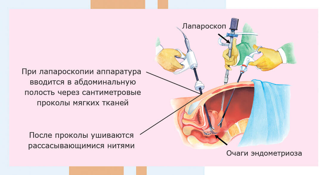 Второй этап операции. Тенорафия этапы операции. Лапароскопия параовариальной кисты. Операции при наружном эндометриозе. Микродискэктомия этапы операции.