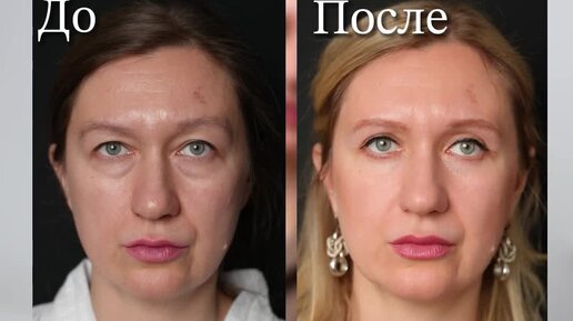 Клиника \"Время Красоты\" | «Я помолодела…» Результат блефаропластики ...