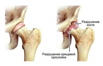 Коксартроз, люмбалгия, армия • Форум призывников