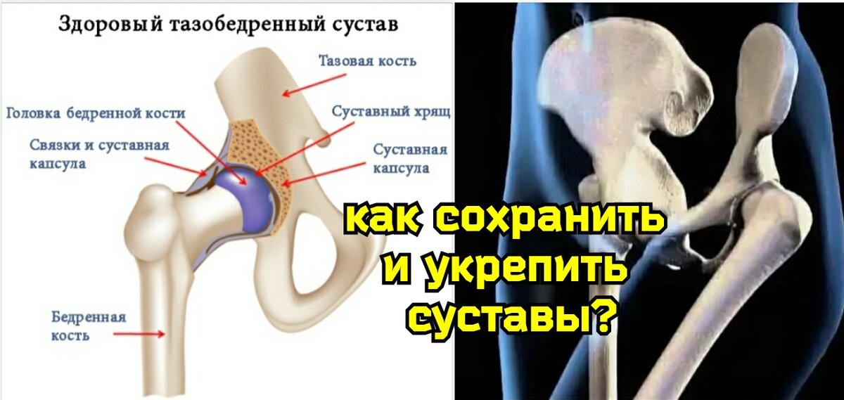 Трохантерит (вертелит) – причины, классификация, признаки, диагностика, лечение - Vertebra